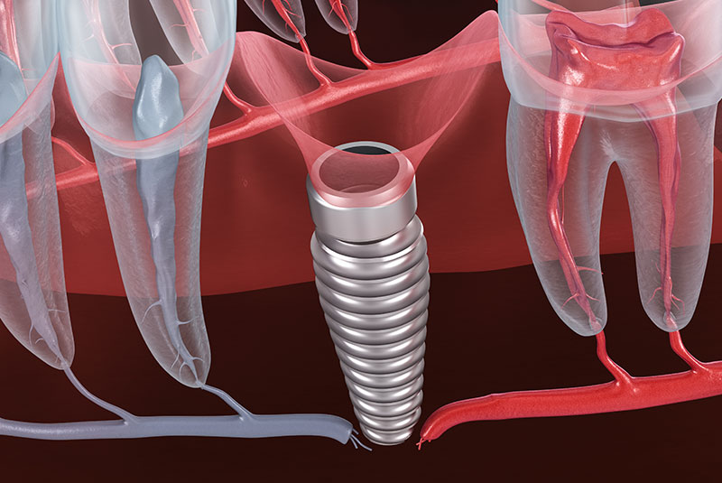 failing dental implant