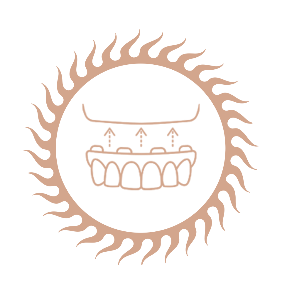 full arch dental implant sun frame