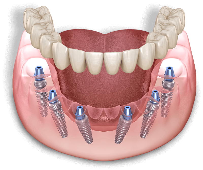 full arch dental implant model illustration