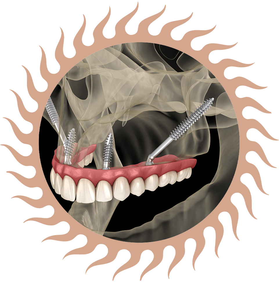 Zygomatic Dental Implant