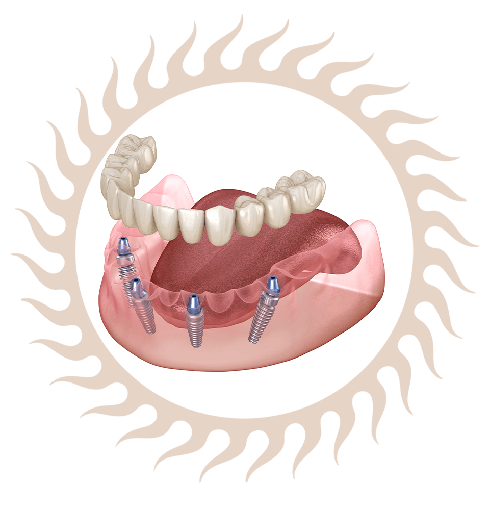 Full mouth implants