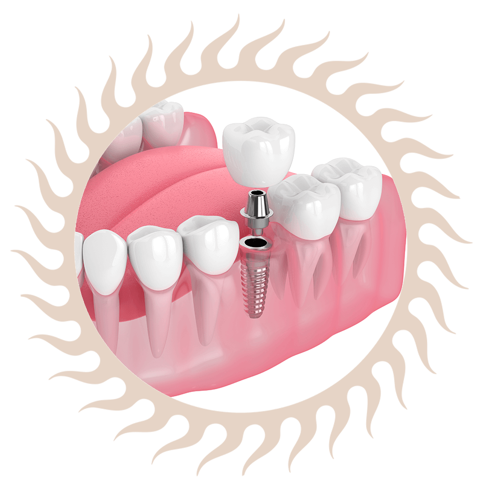 single dental implant