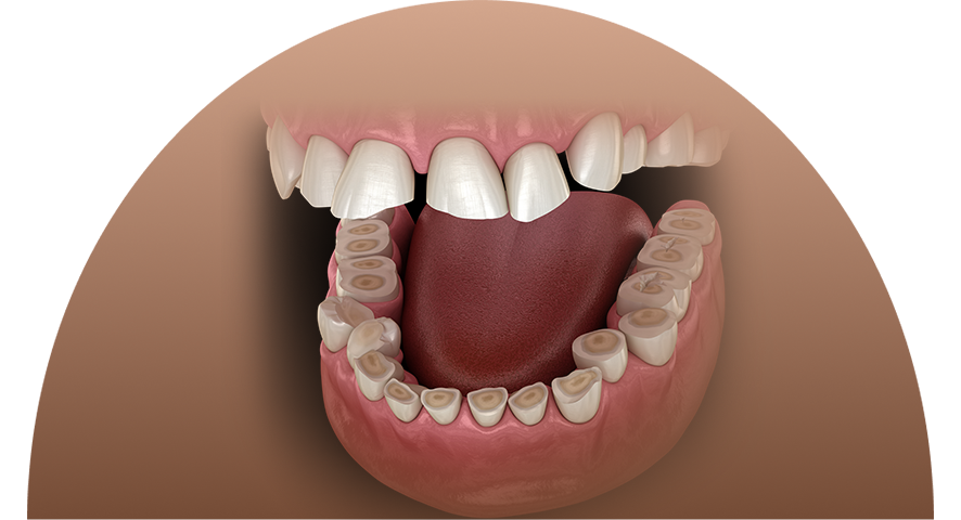 bruxism